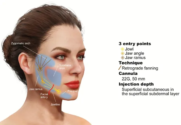 Rostro de mujer con las zonas de tratamiento del inyectable híbrido sombreadas en el área submalar y la línea mandibular, y tres puntos de entrada (jowl, ángulo y rama mandibular) con cánula 22 G de 50 mm en abanico retrógrado, en el plano subdérmico superficial